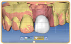 手術後の仮歯のシミュレーション