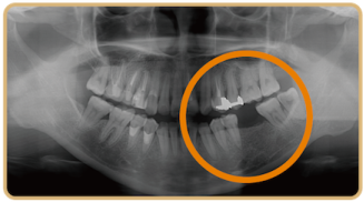 抜歯後のレントゲン写真