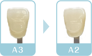 ホワイトニング1回目終了後　歯の色