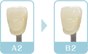 ホワイトニング1回目終了後　歯の色