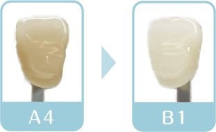 ホワイトニング7回目終了後　歯の色