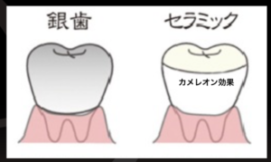銀歯　セラミック