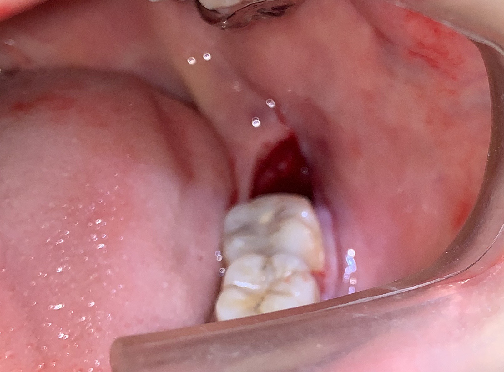 親知らずの抜歯後に食べてはいけないもの