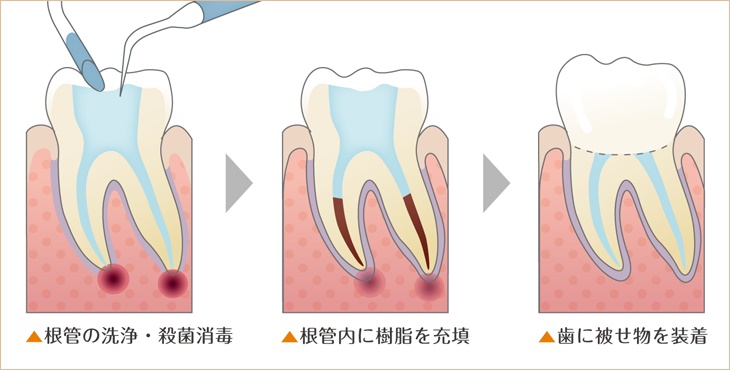  できるだけ歯を保存できるように根管治療を行っております。