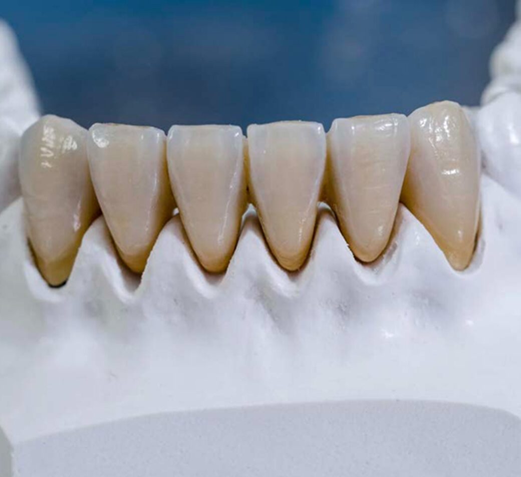 独自のハートフル歯科式ワンデイジルコニア治療